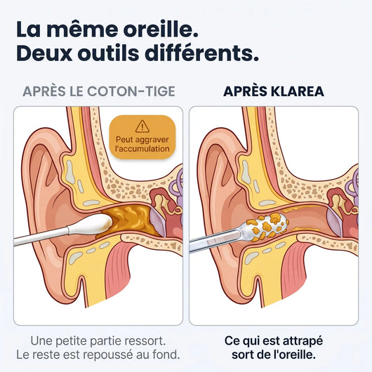 Klarea Pro® Nettoyeur d'oreille adhésif